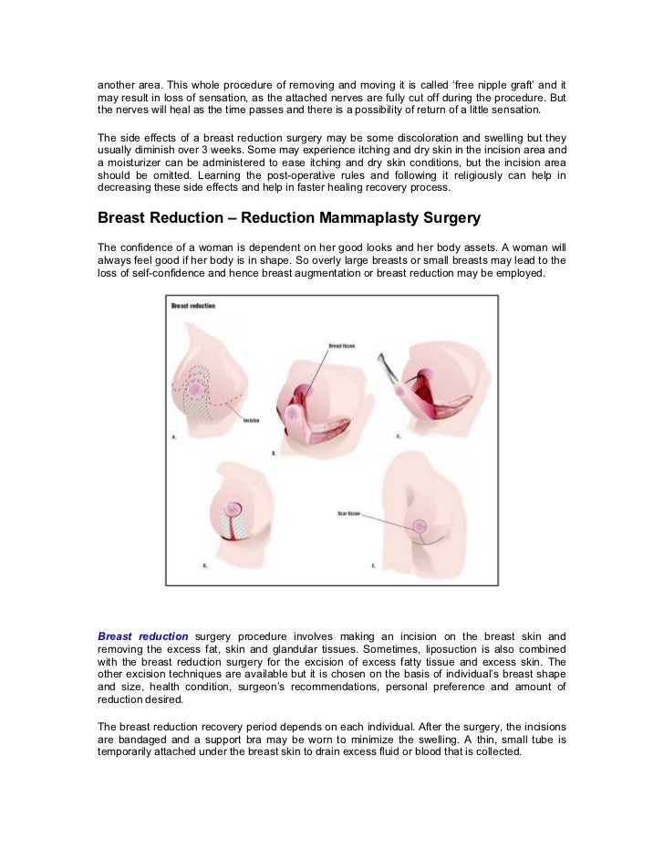 surgery breast reduction side effects Surgery breast reduction side effects